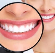 Hollywood Smile in Turkey: pros, cons, and cost