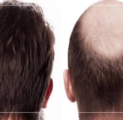 زراعة الشعر قبل وبعد بالصور في عيادة علاجك الطبية
