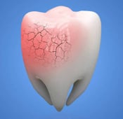 تفتت الأسنان : الأعراض وطرق العلاج