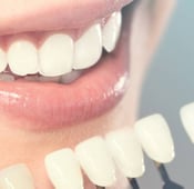 Dental Veneers in turkey