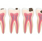 Types of tooth decay, its stages and how to treat it