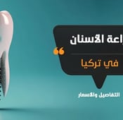 زراعة الأسنان في تركيا: الأسعار وأفضل المستشفيات