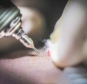 ما هو الفرق بين زراعة الشعر في مصر وتركيا 2025