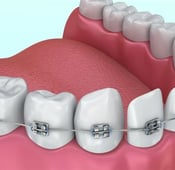 أنواع تقويم الأسنان بالصور: الأسعار والمميزات والعيوب