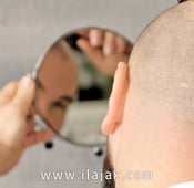 أفضل علاجات الصلع الوراثي: من الأدوية إلى زراعة الشعر