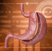 تجارب نزول الوزن بعد التكميم لدى علاجك الطبية