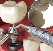 Which is better delayed or immediate dental implants?