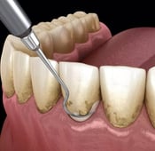 أهم 13 من أمراض الأسنان واللثة