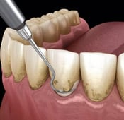أهم 13 من أمراض الأسنان واللثة