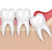 التهاب ما حول التاج: الأسباب، الأعراض، وطرق العلاج