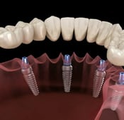 Dental implants in Istanbul
