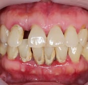 التهاب دواعم الأسنان: الأعراض، الأسباب والعلاج