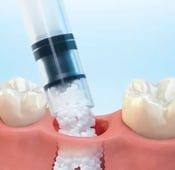 Dental implant step by step procedure in turkey