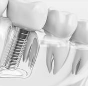 دليلك الشامل للتعرف على زراعة الأسنان بدون جراحة