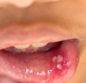 أسباب تقرحات الفم وكيف يتم علاجها