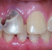 Cavities on front teeth facts