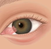ظفر العين : الأسباب والأعراض وطرق العلاج