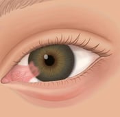 ظفر العين أو لحمية العين: ماهي أسبابه وطرق علاجه؟