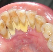 Le tartre dentaire : causes, traitement et prévention