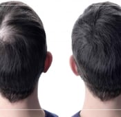 أفضل مركز زراعة الشعر في اسطنبول