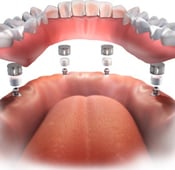 All on four dental implants in Turkey