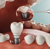 4 common alternatives to dental implants