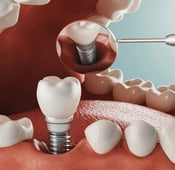 أهم بدائل زراعة الأسنان: مميزاتها وعيوبها