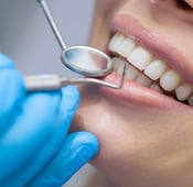 In-Office Teeth Whitening Options and advantages