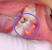 خراج الأسنان : تشخيصه و علاجه و الوقاية منه