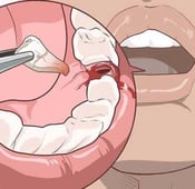 ما هي أسباب تسوس ضرس العقل وكيفية علاجه؟