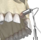 Bone graft procedure for a dental implant, the cost in turkey