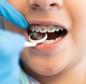 دليل مفصل حول تقويم الأسنان للأطفال