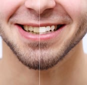Teeth whitening: what is it, is it safe, and what are available options?