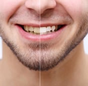 تبييض الأسنان: أنواع تبييض الأسنان وأفضلها