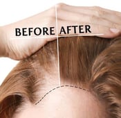 زراعة الشعر للنساء في تركيا: أحدث تقنيات 2025