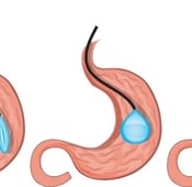 Intragastric Balloon