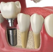 Implant dentaire : la mise en charge immédiate