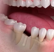 طرق تعويض الأسنان المفقودة