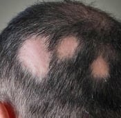 Les causes de la pelade - alopécie areata