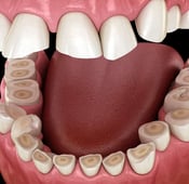صرير الأسنان: الأعراض، الأسباب والعلاج