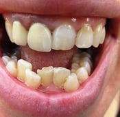 مشاكل اعوجاج الأسنان وطرق علاجها