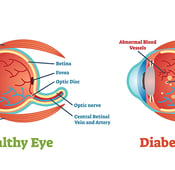 أمراض العيون بسبب مرض السكري: أسبابها وطرق علاجها