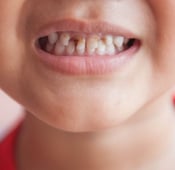 أسباب تسوس الأسنان عند الأطفال وكيف يمكن علاجها