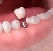 Dental implants experience in Turkey with ILAJAK Medical
