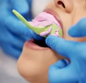 ما هي أنواع طبعات الأسنان وأهميتها العلاجية؟