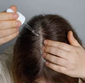 فوائد المينوكسيدل بعد زراعة الشعر: هل هو ضروري؟