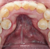 علاج الأسنان الزائدة أو فرط الأسنان