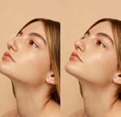 تجميل الأنف في تركيا: دليل مفصّل مع الأسعار 2025