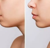 عمليات تجميل الذقن: دليل شامل