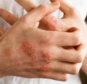 Les causes de l'eczéma